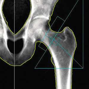 DEXA Osteoporosis Test in Lakeland, FL - Women's Imaging Center