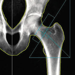 DEXA Scan (DXA): Bone Density Test, What Is It & How It's Done